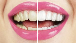 5 Natural Ways to Whiten Your Teeth at Home