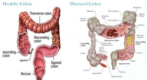 Up To 30 Pounds of Harmful Toxins Are Accumulated In Your Colon – Here Is What You Can Do